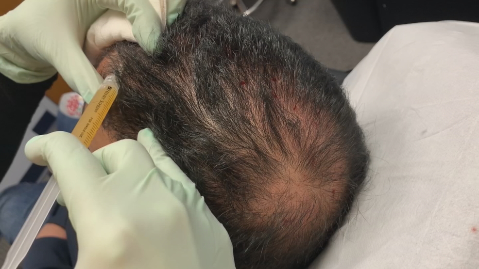 Health Check New nonsurgical treatment for hair loss WJAR