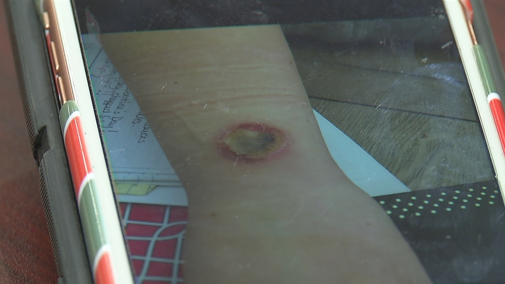 Phone chargers pose severe burn risk WJAR