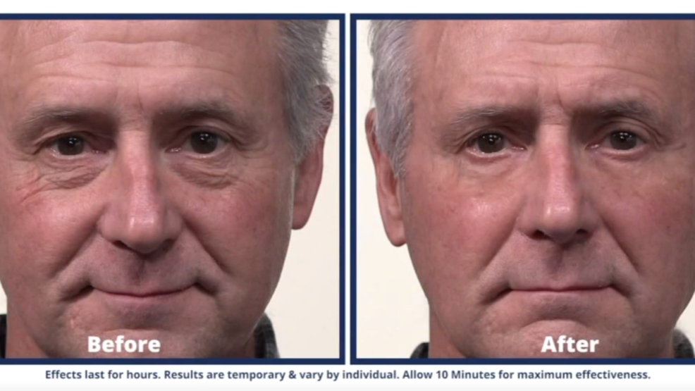 plexaderm for wrinkles