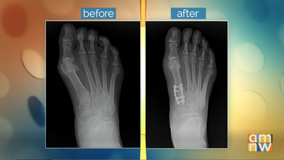Elite Foot & Ankle Associates: Treating Bunions | KATU